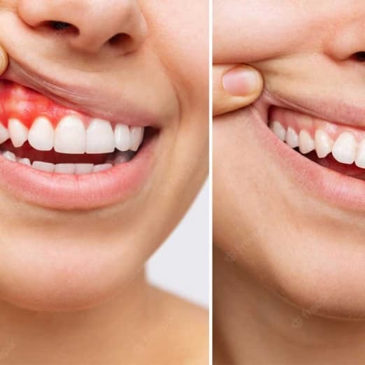 Gum Treatment in Surat