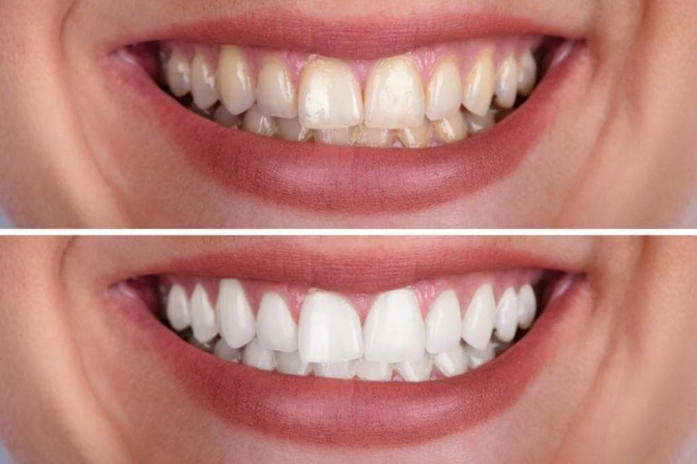 Teeth Whitening / Brightening in Surat