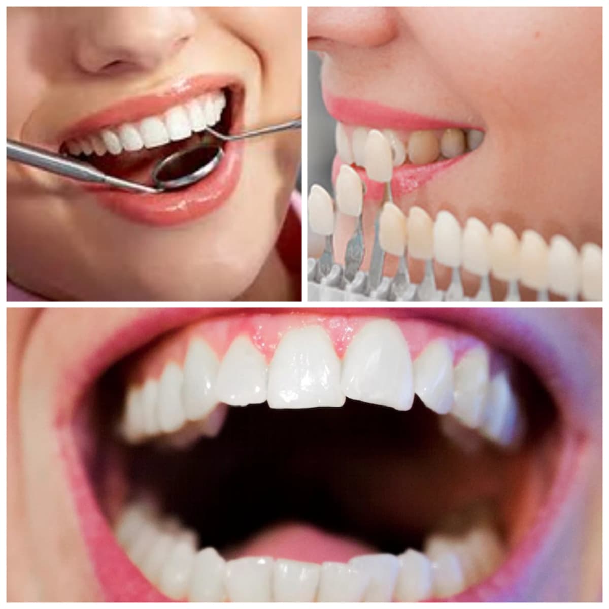 Complete Smile Transformation in Surat